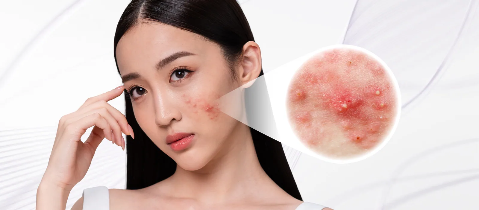 Acne condition overview