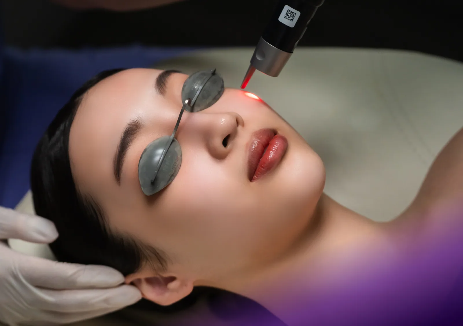 Pico Laser treatment at Clinic RX