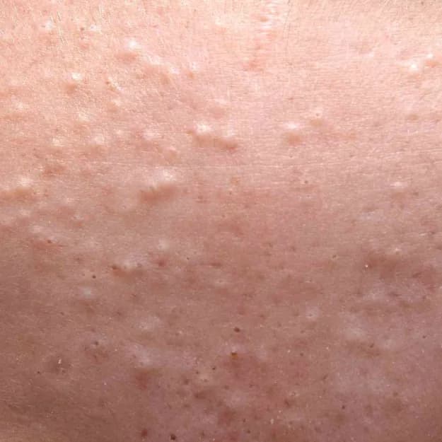 Acne — Hormonal Acne