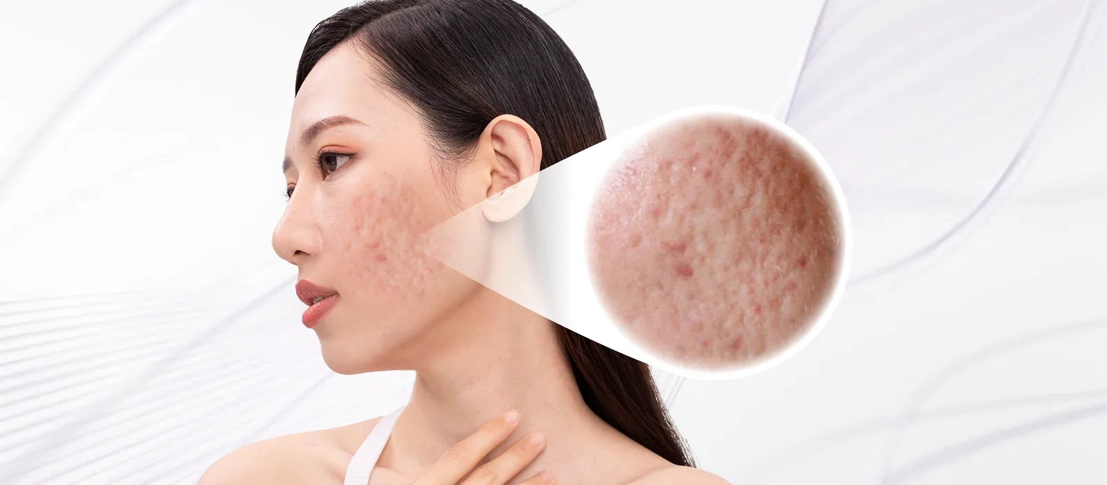 Acne Scars condition overview