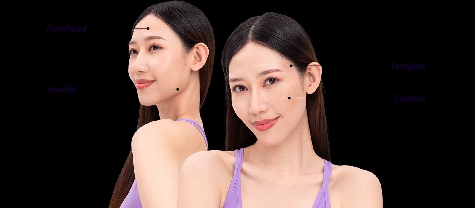 Acne Scars commonly affected areas