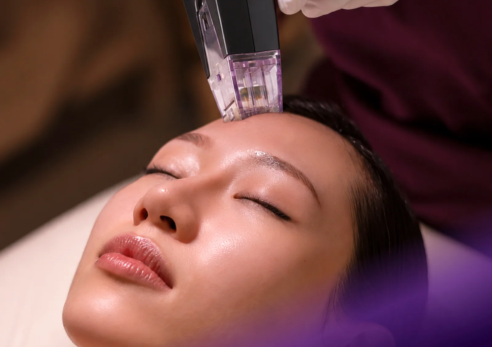Morpheus8 treatment at Clinic RX