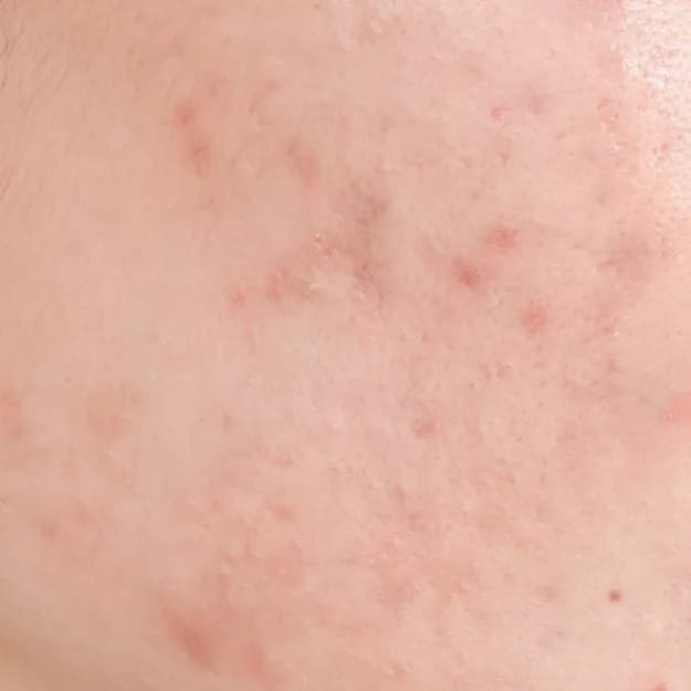 Acne Scars — Post-Inflammatory Hyperpigmentation (PIH)