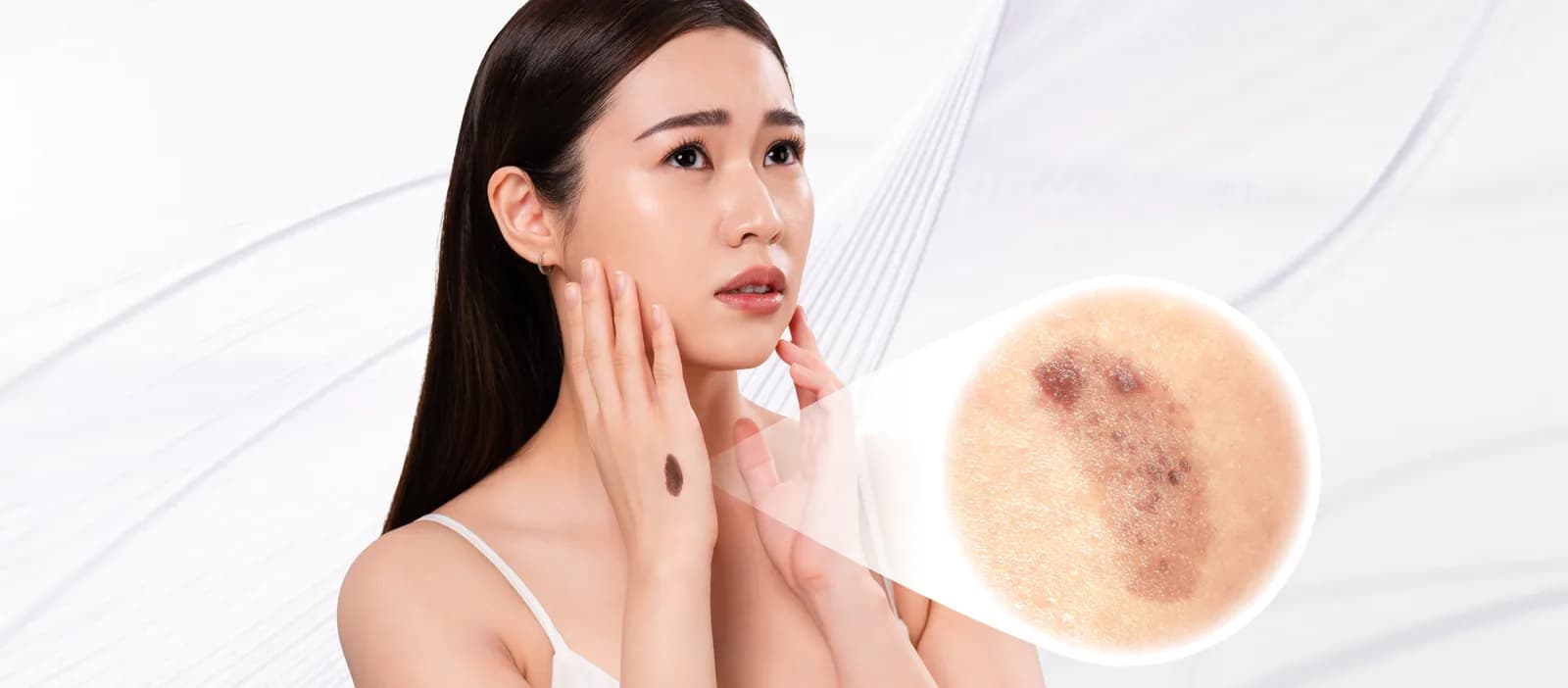Birthmark condition overview