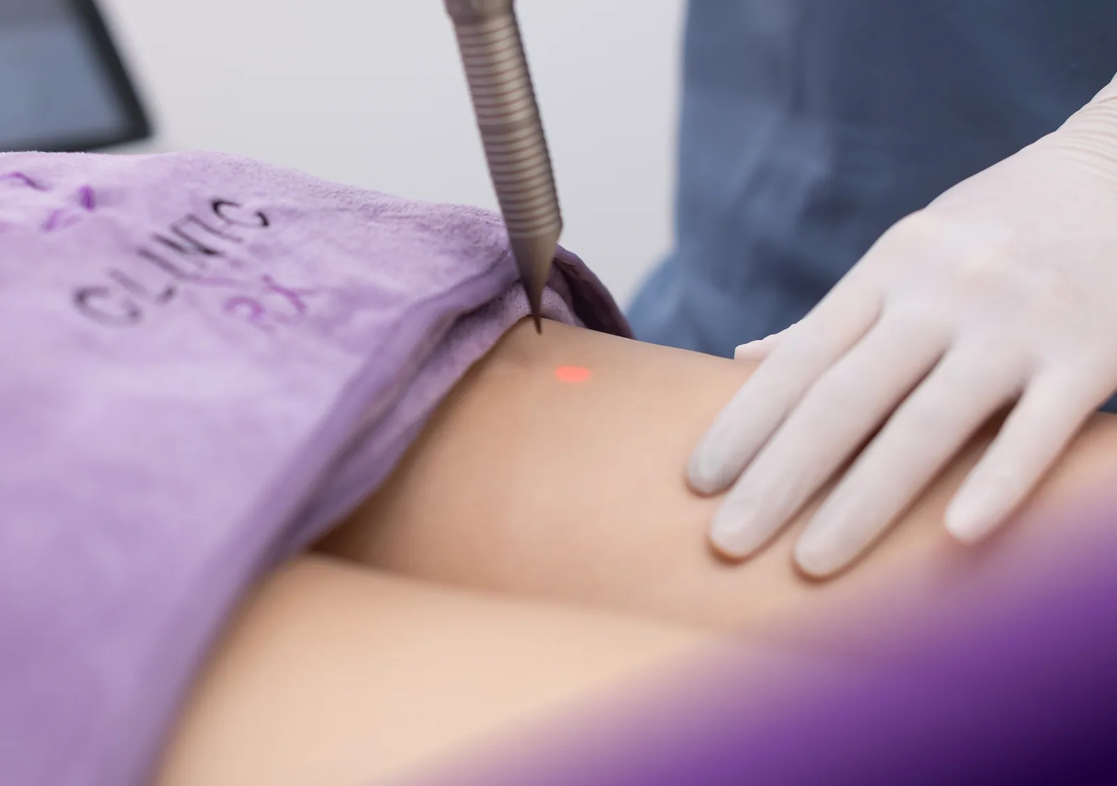 Vascular Laser treatment at Clinic RX