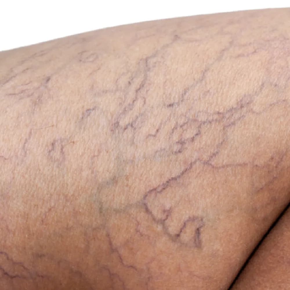 Birthmark — Vascular Birthmarks