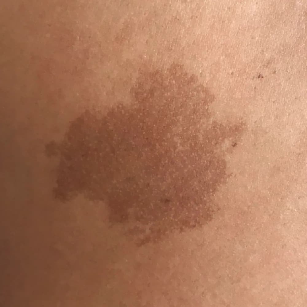 Birthmark — Mixed Birthmarks