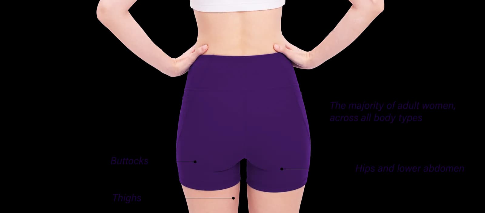 Cellulite commonly affected areas