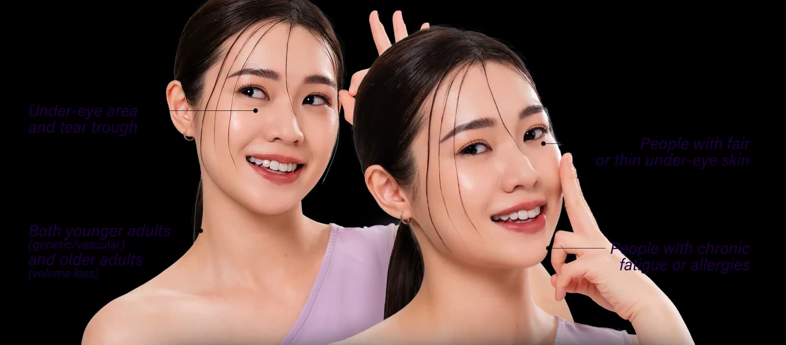 Dark Eye Circles commonly affected areas