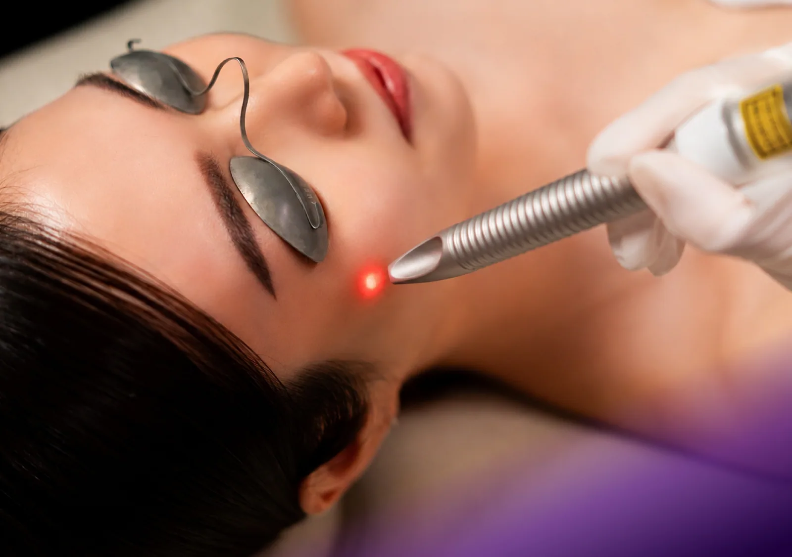 Vascular Laser treatment at Clinic RX