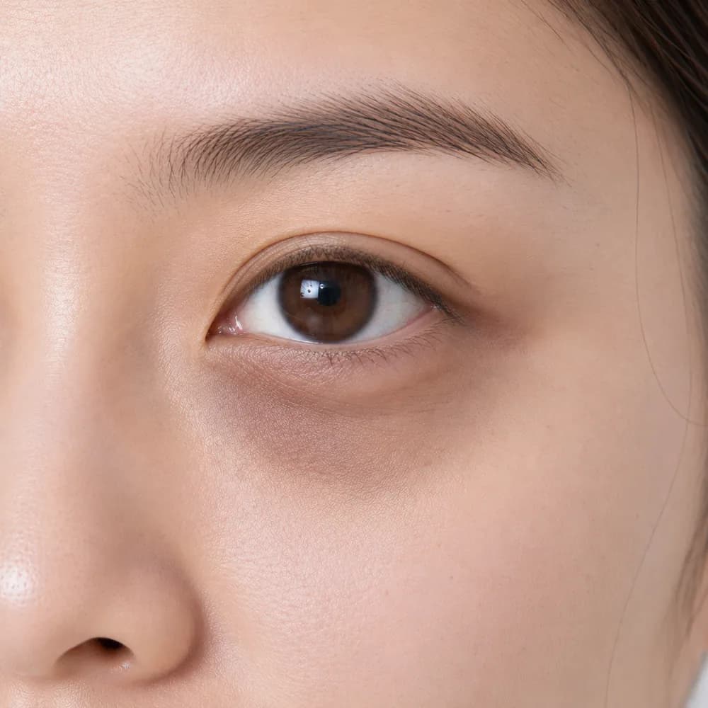Dark Eye Circles — Mixed Dark Circles