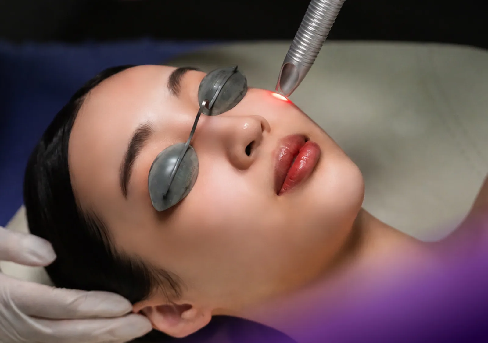 Fotona 4D Lift (Smootheye) treatment at Clinic RX