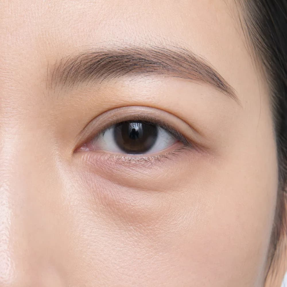 Eyebags — Skin-Related Eyebags