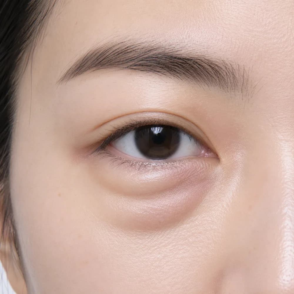 Eyebags — Fluid-Related Puffiness
