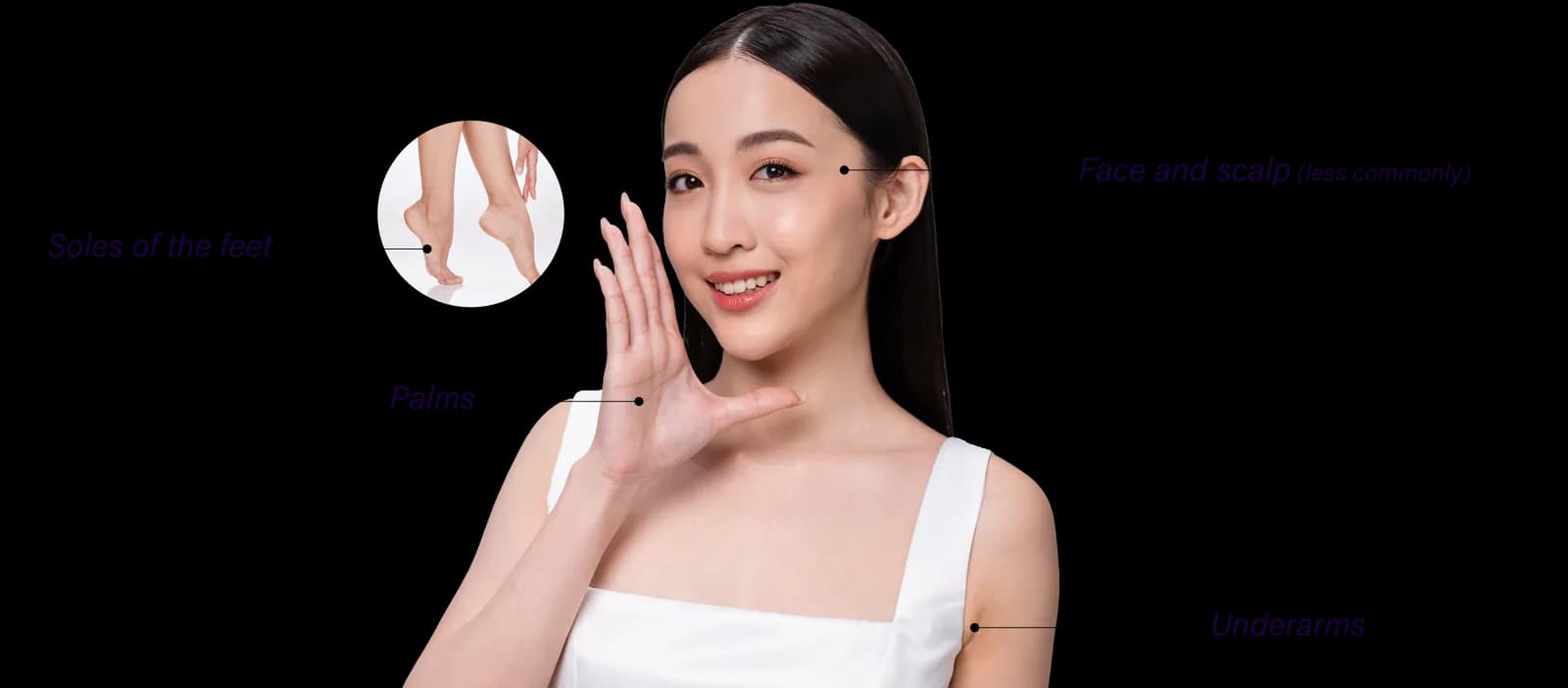 Hyperhidrosis commonly affected areas