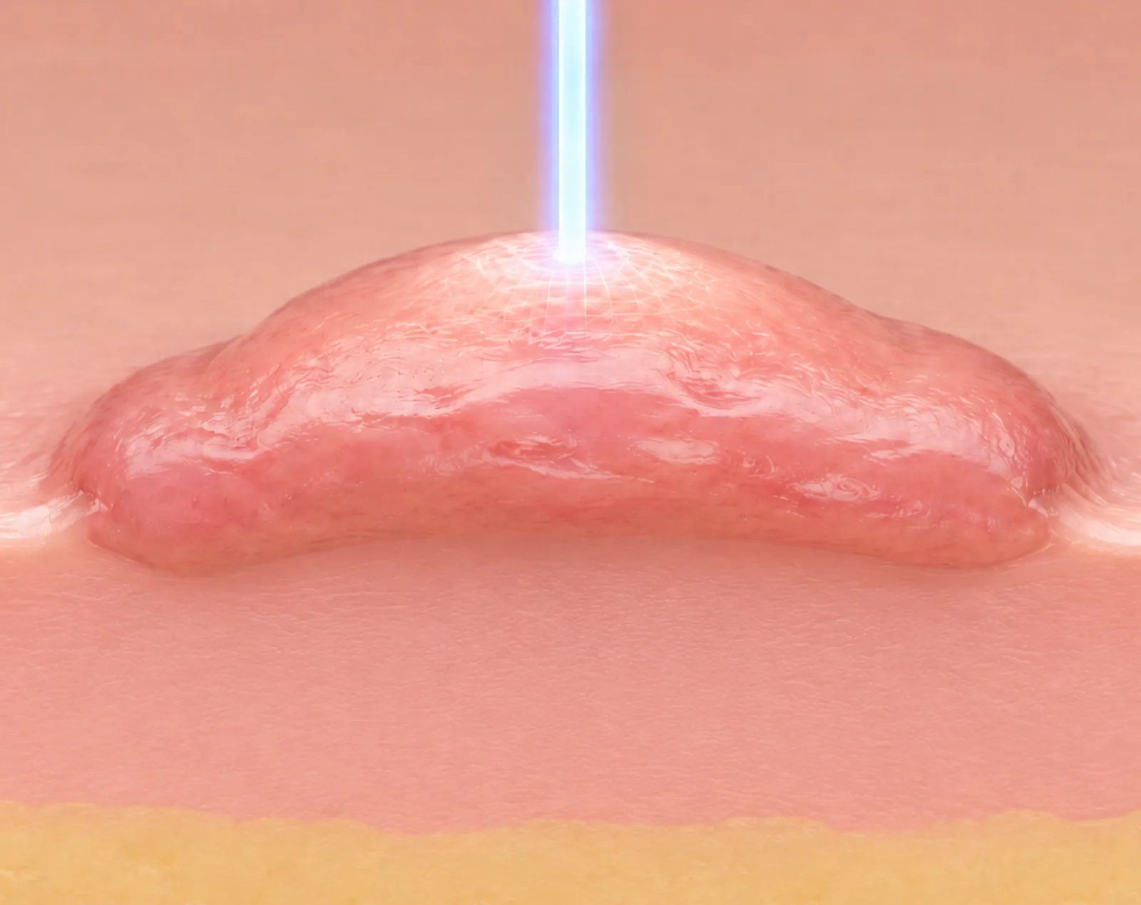 Keloid anatomy and overview
