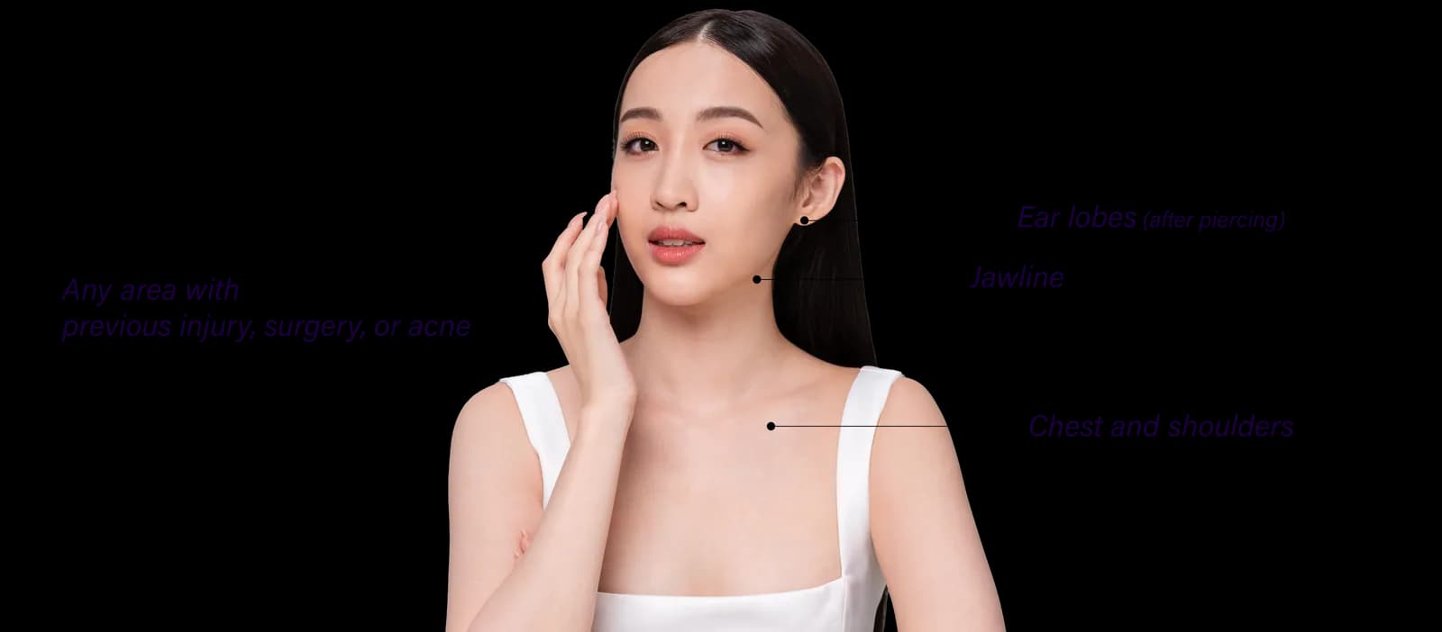 Keloid commonly affected areas