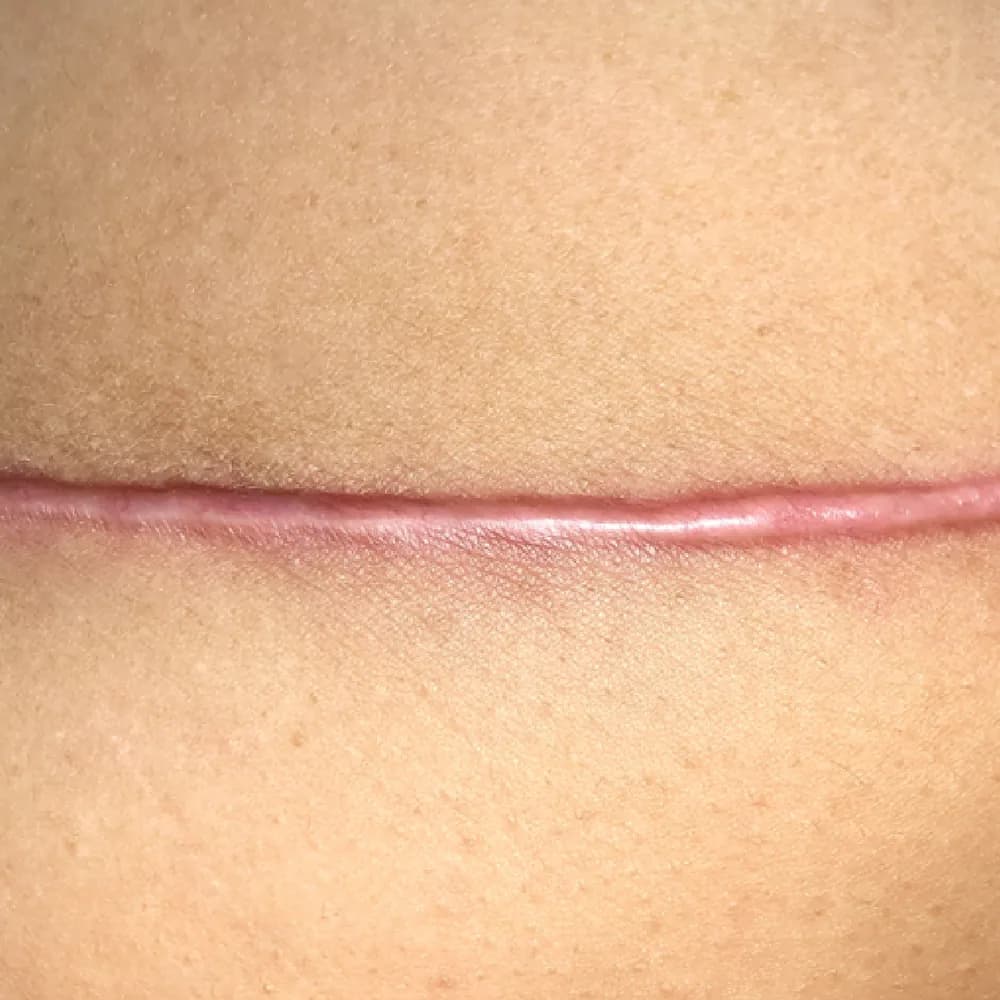 Keloid — Keloid Scar