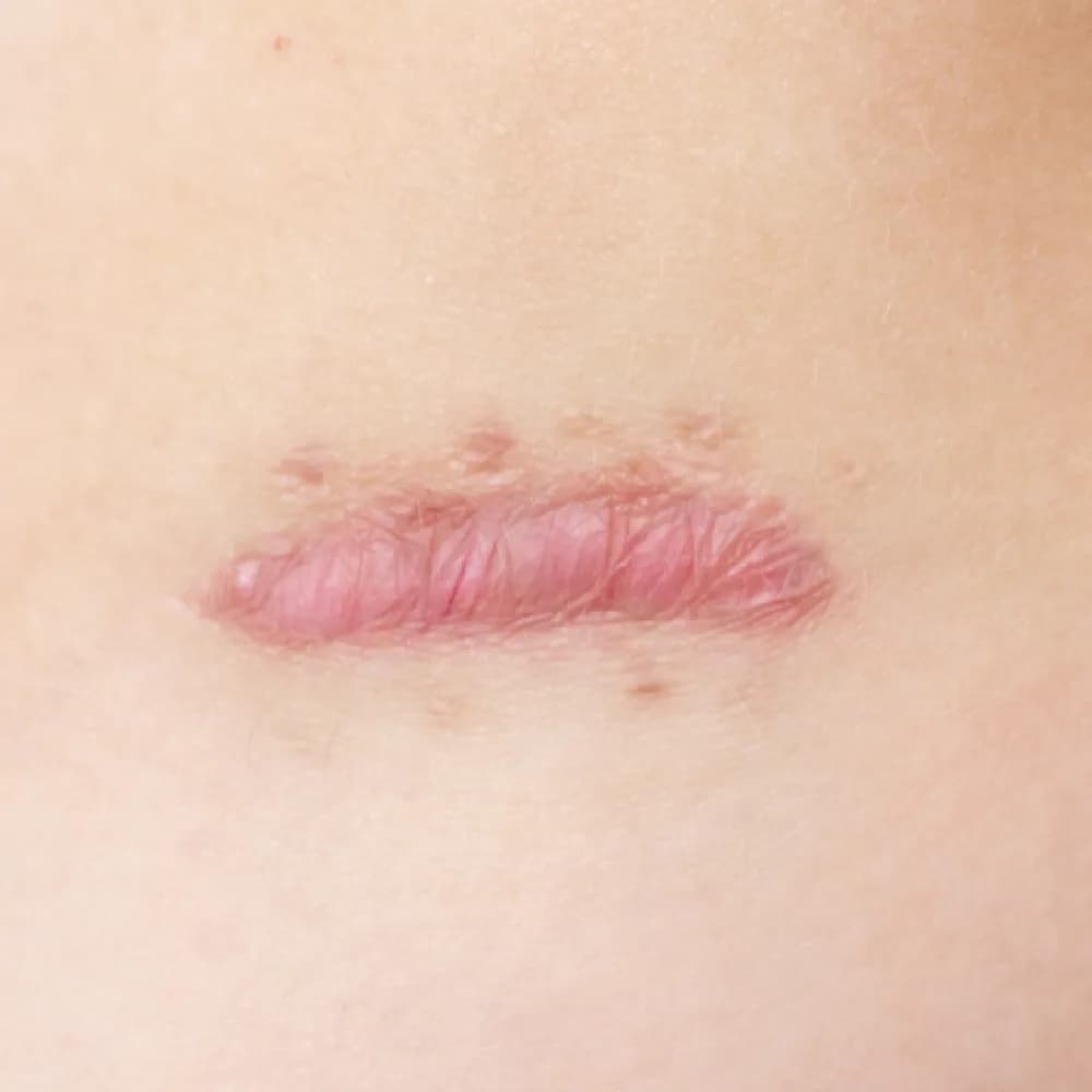 Keloid — Hypertrophic Scar