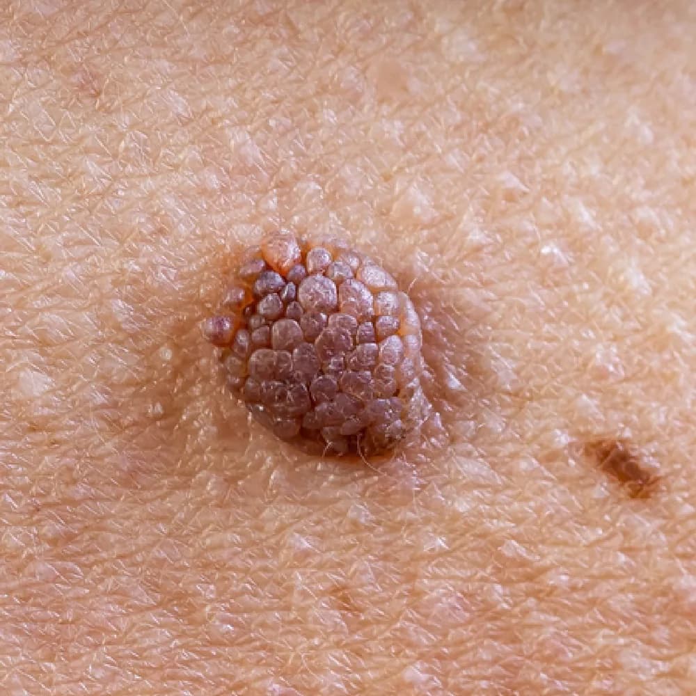 Mole — Raised Moles