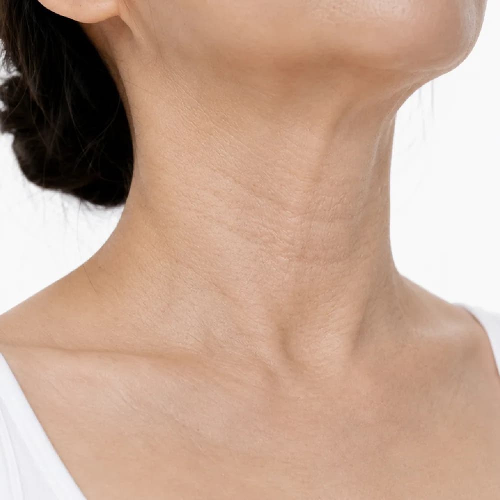 Neck Lines — Skin Laxity / Sagging