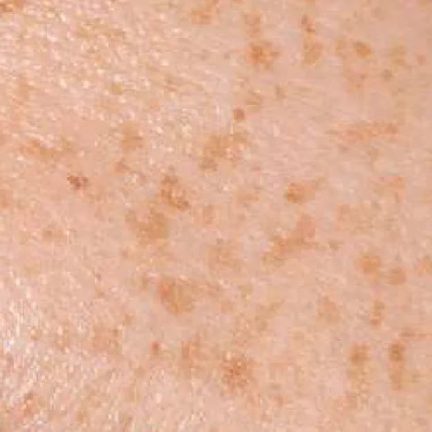Pigmentation — Freckles