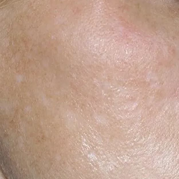 Pigmentation — Uneven Skin Tone
