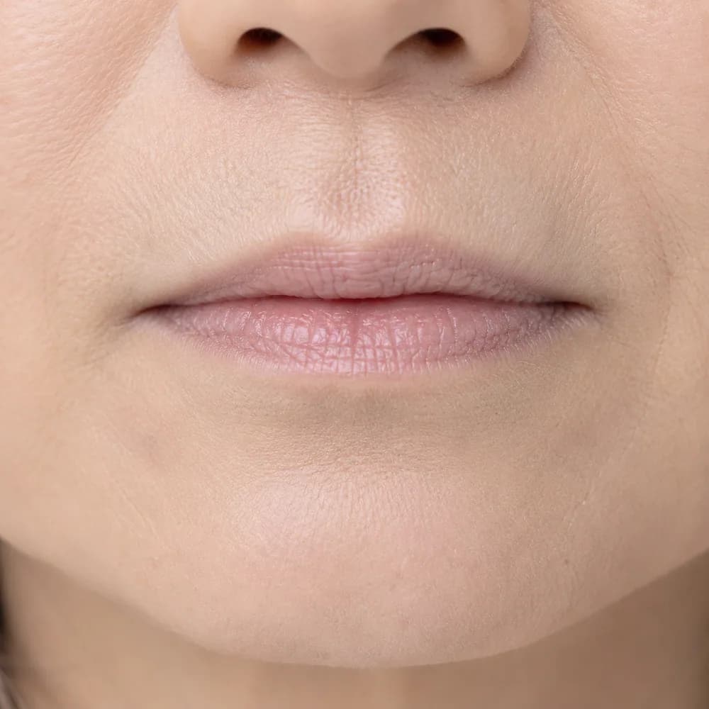 Thin Lips — Age-Related Volume Loss