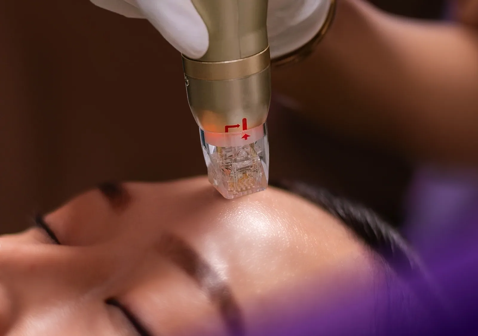Sylfirm X treatment at Clinic RX