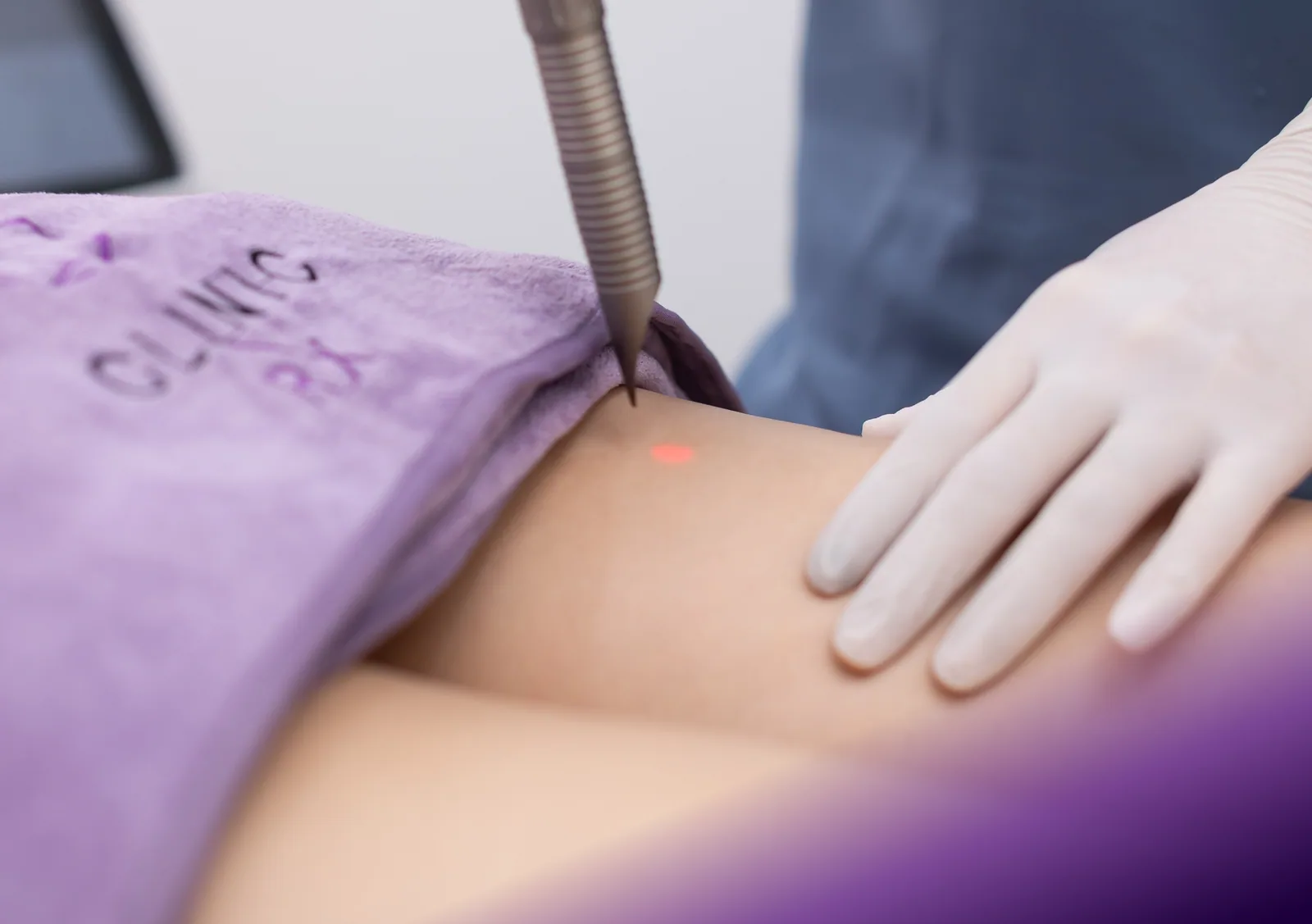 Fotona TightSculpting treatment at Clinic RX