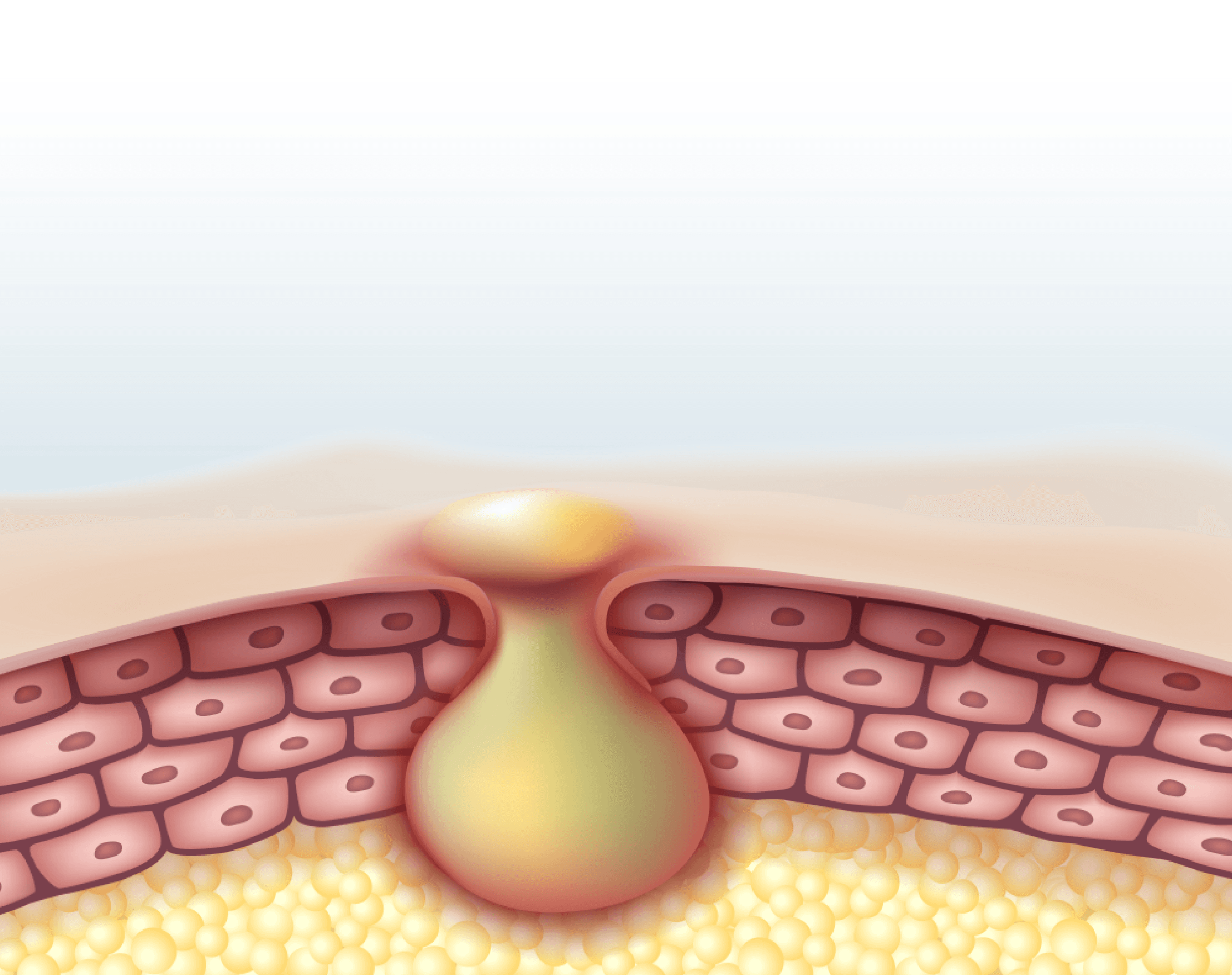 Acne overview illustration