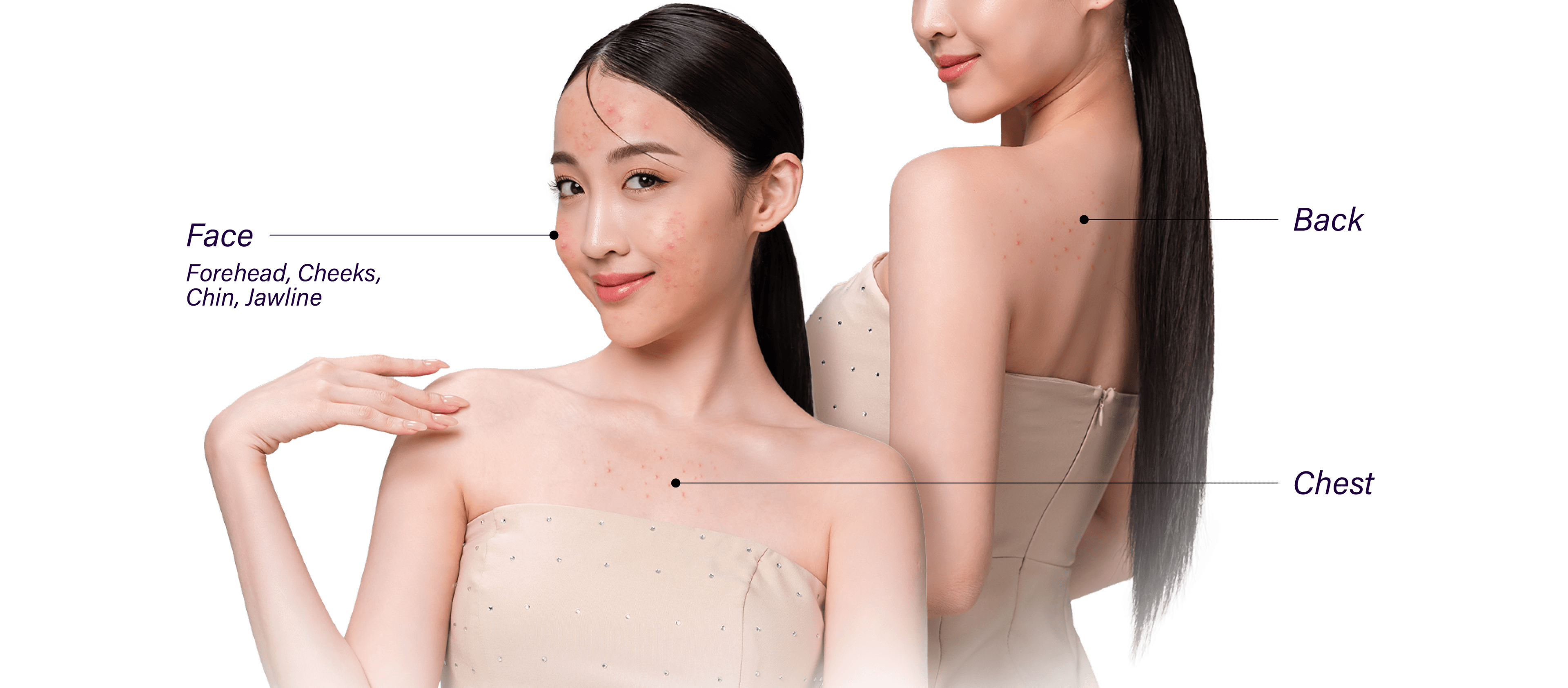 Areas commonly affected by acne