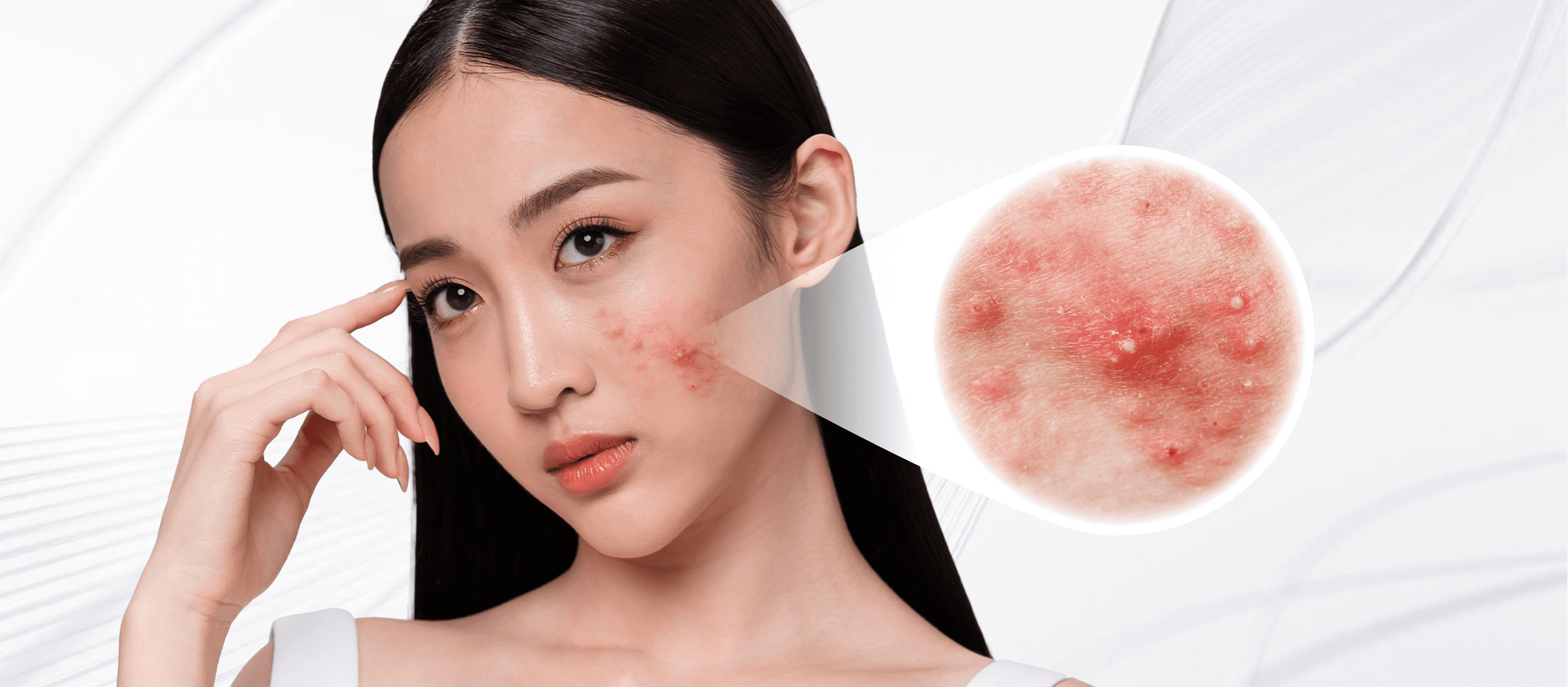 Acne condition overview