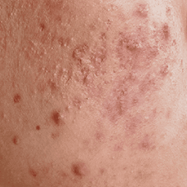 Adult-Onset Acne