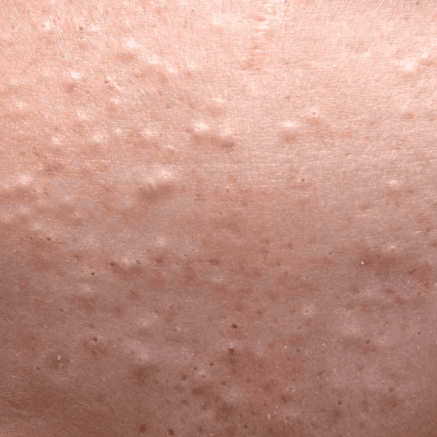 Comedonal Acne