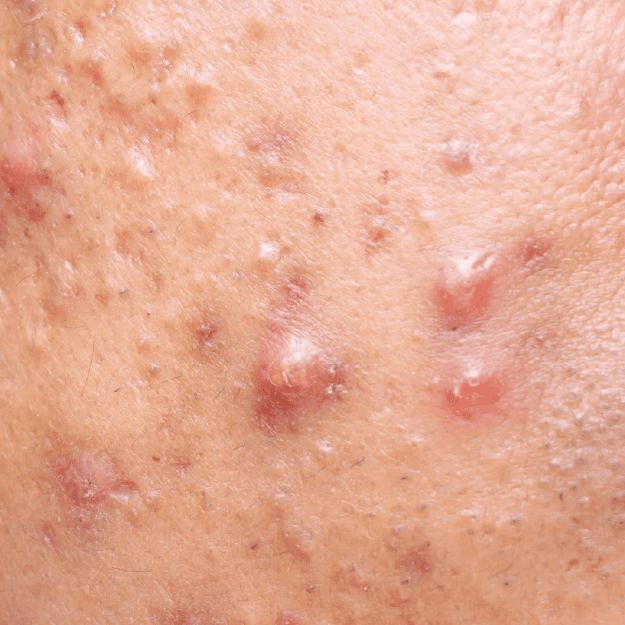 Cystic Acne