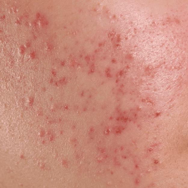 Hormonal Acne