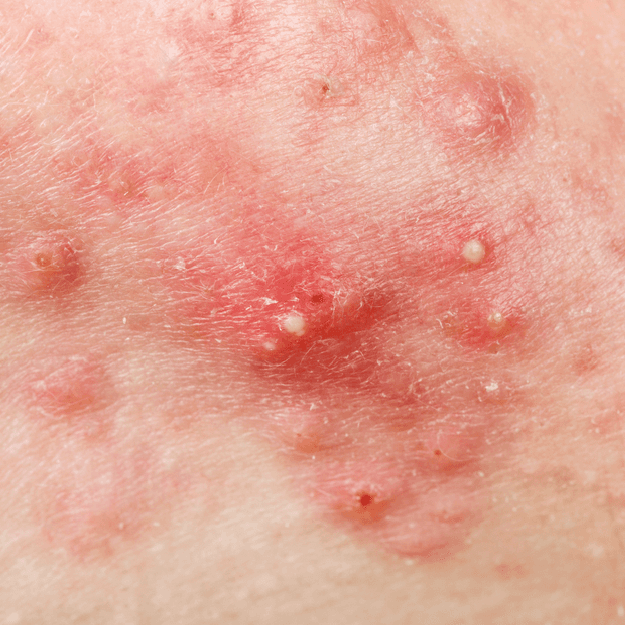 Inflammatory Acne