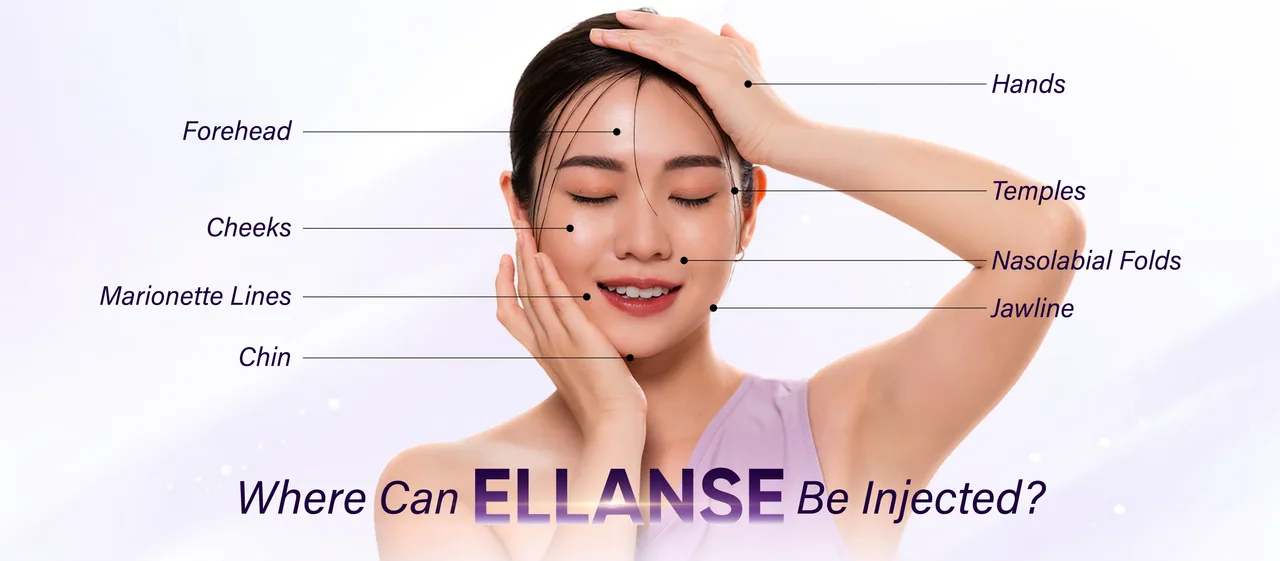 Ellansé treatment areas