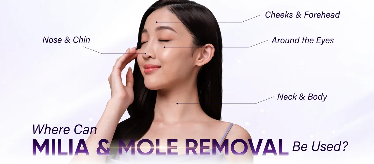 Milia and mole removal treatment areas