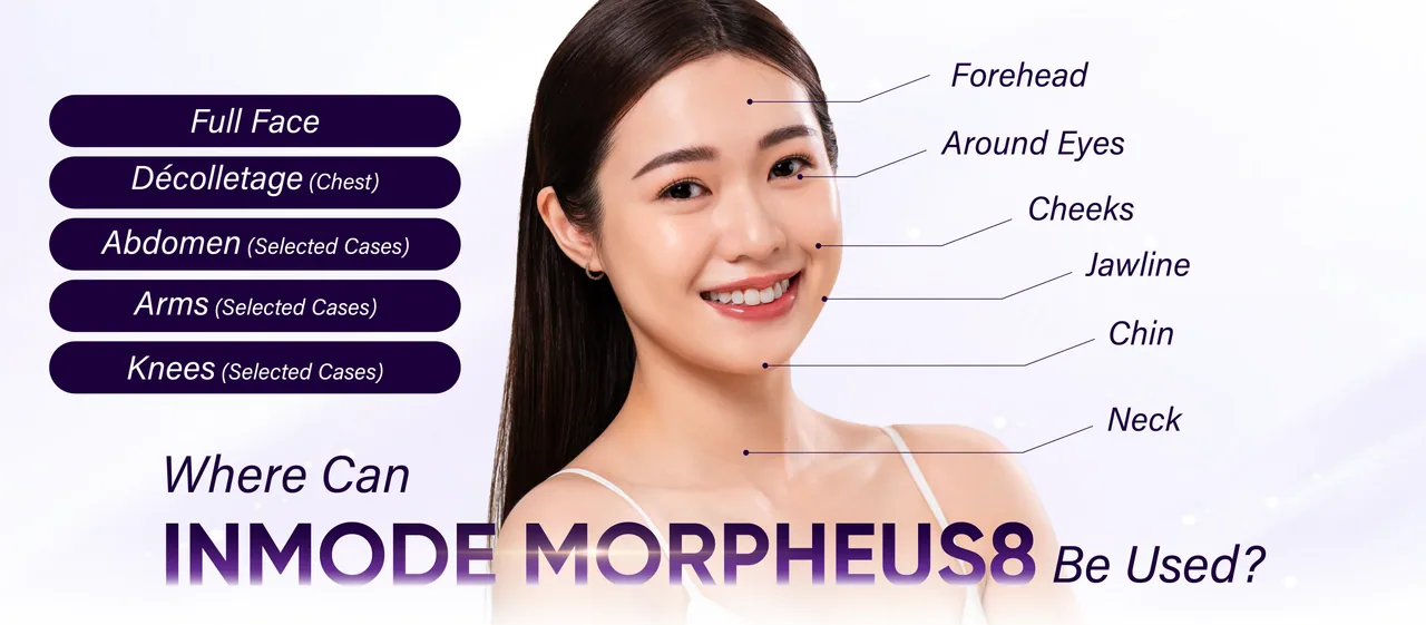 InMode Morpheus8 treatment areas