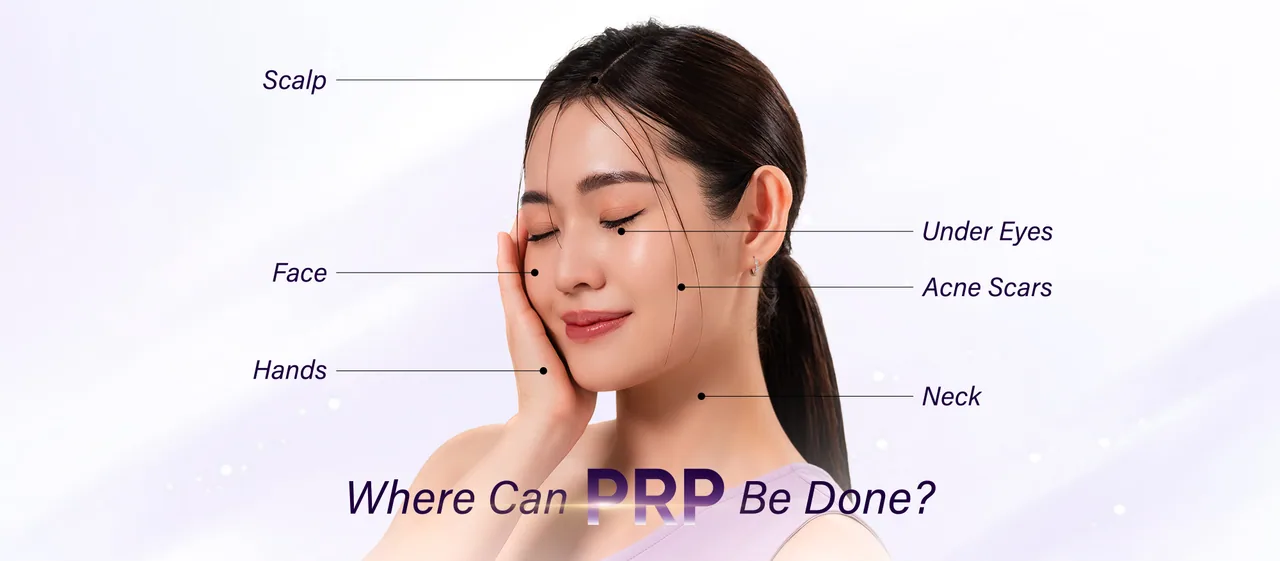 PRP Treatment treatment areas