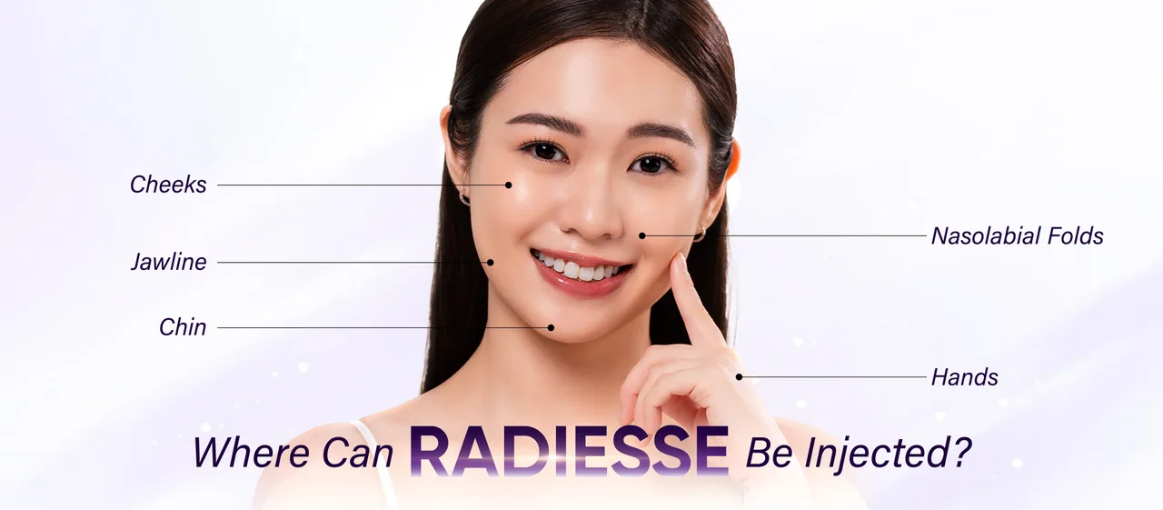 Radiesse treatment areas