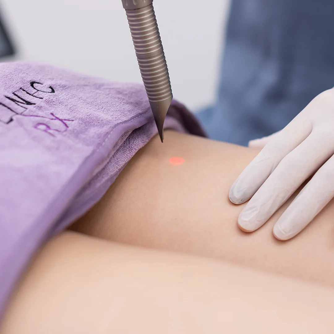 Vascular Laser treatment at Clinic RX