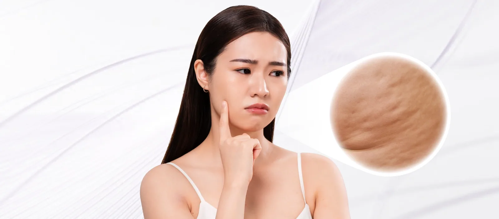 Cellulite condition overview