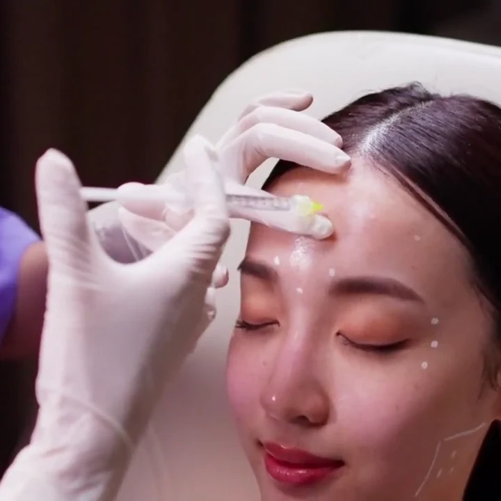 Dermal Filler treatment at Clinic RX