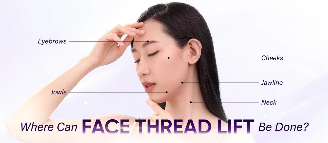 Face Thread Lift treatment areas