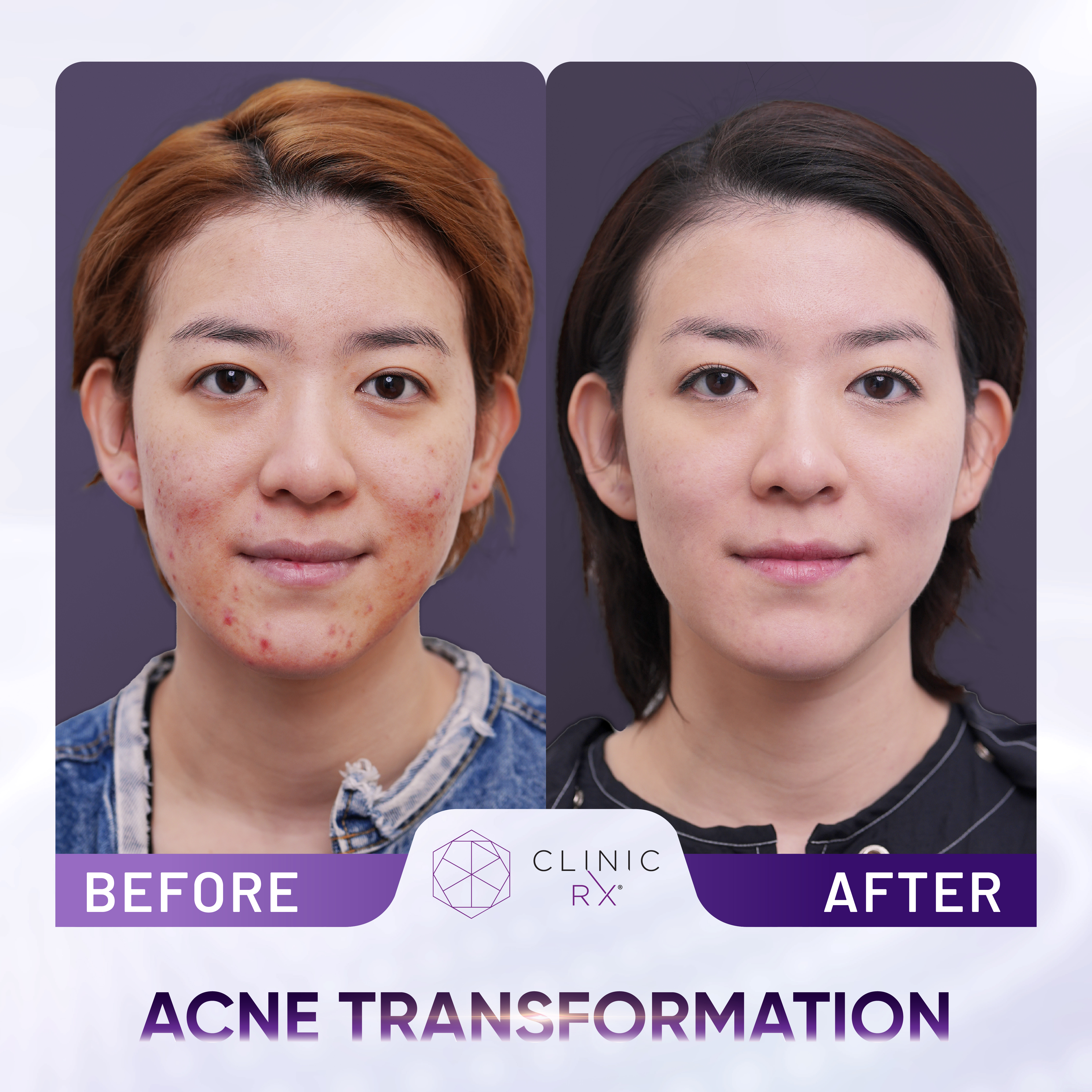 Acne result 1
