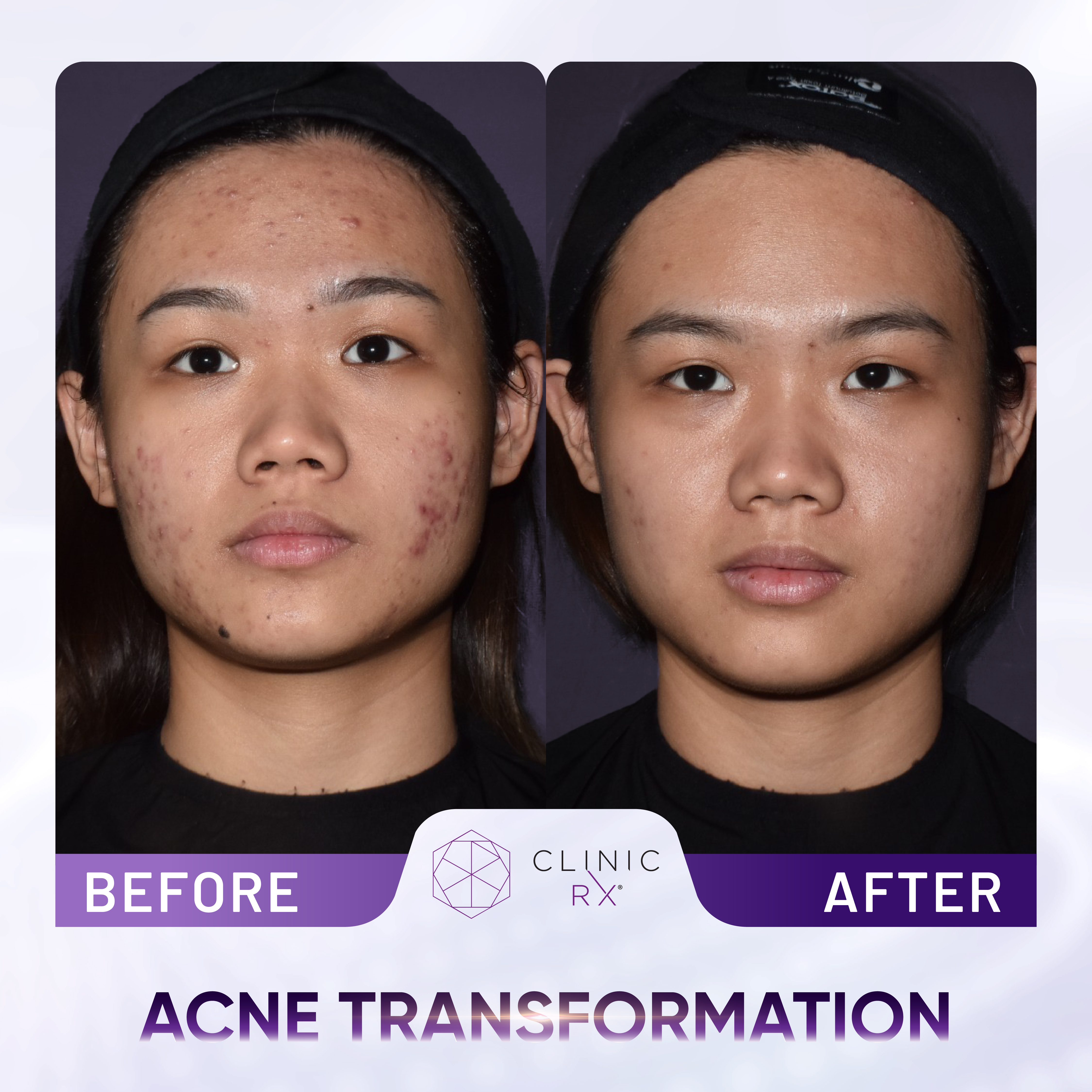 Acne result 2