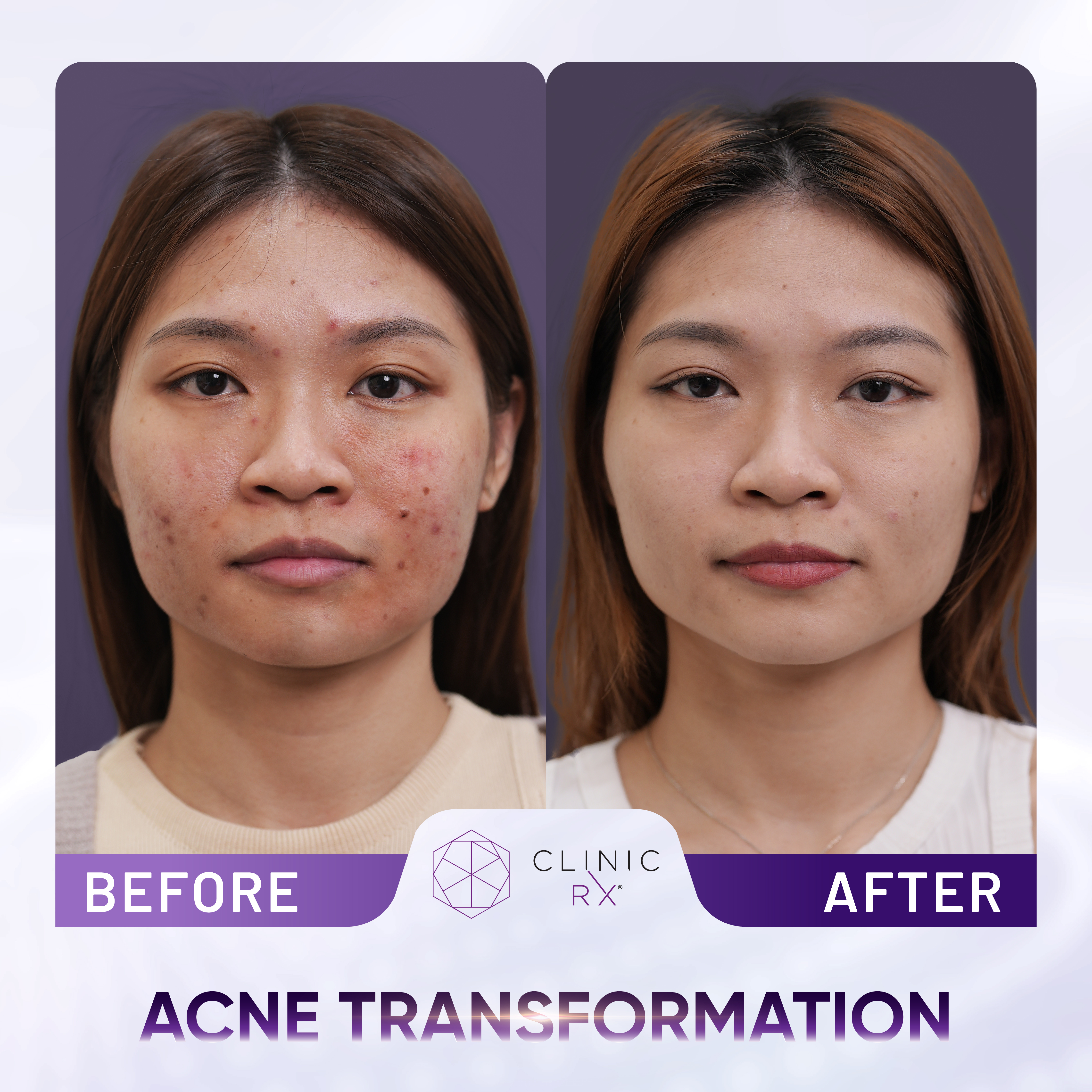 Acne result 3